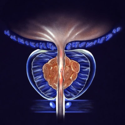 Prostate Gland – (BPH) Benign Prostatic Hyperplasia, Stage 2 – false color to highlight details