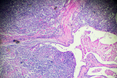 Hodgkin.s cells disease, Lymphoma, HL under microscopy