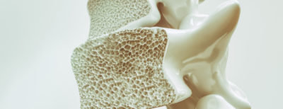 Wirbelsauele Osteoporose Knochen