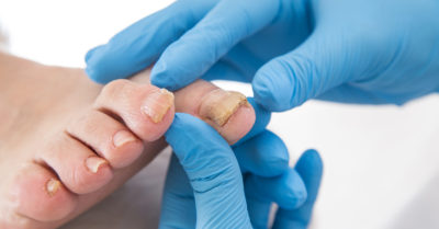 Ab 1. Juli können Ärzte bei Patienten mit eingewachsenen Zehennägeln eine Behandlung mit Nagelkorrekturspangen durch den Podologen verordnen.