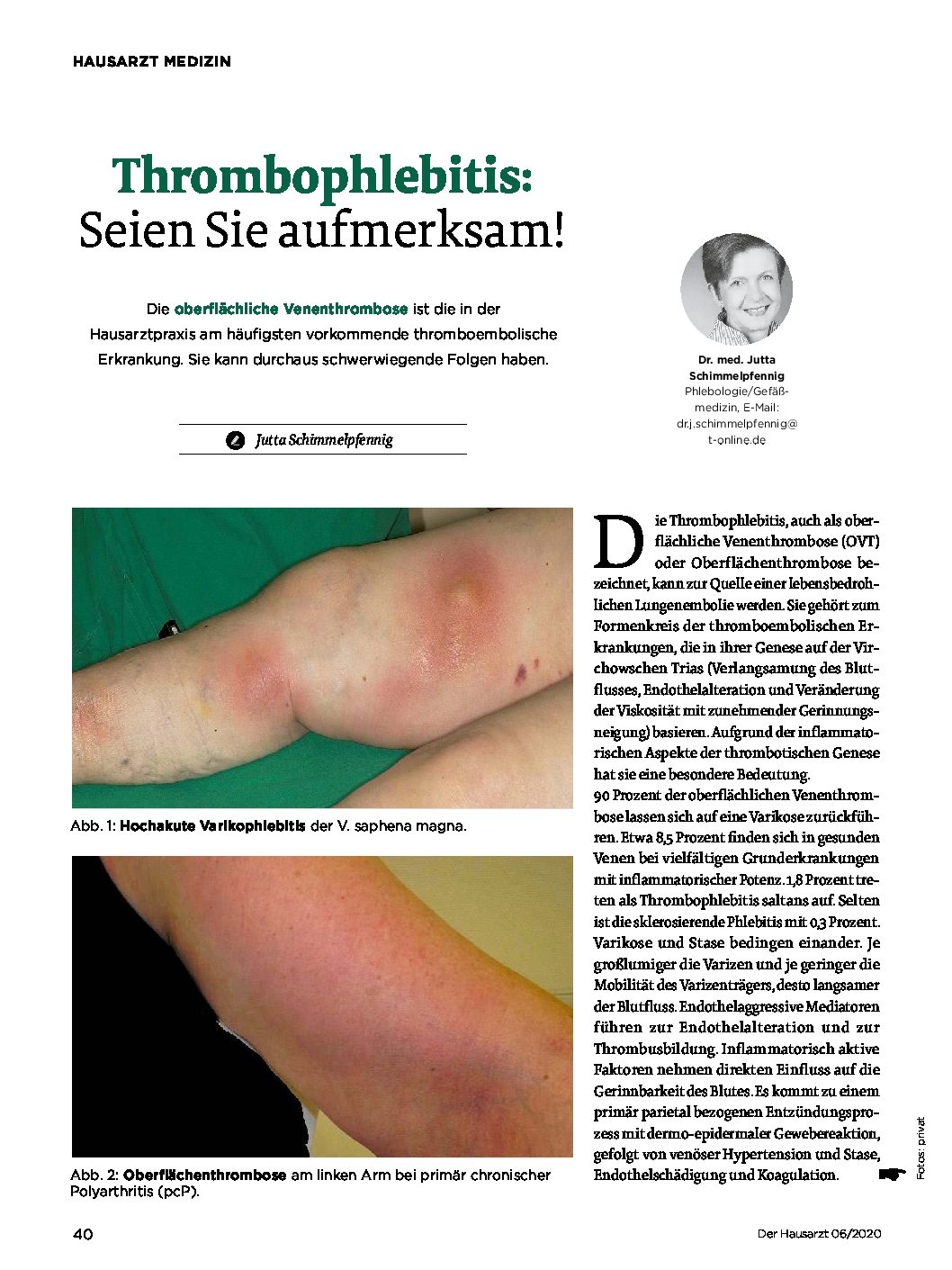 Ist eine oberflächliche thrombophlebitis was Gesundheitslexikon: Thrombophlebitis