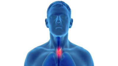 Der Hausarzt 15/2020 hausarzt.digital Erhaltungstherapie EoE Eosinophile Ösophagitis 3D Illustration of esophageal cancer in the human male