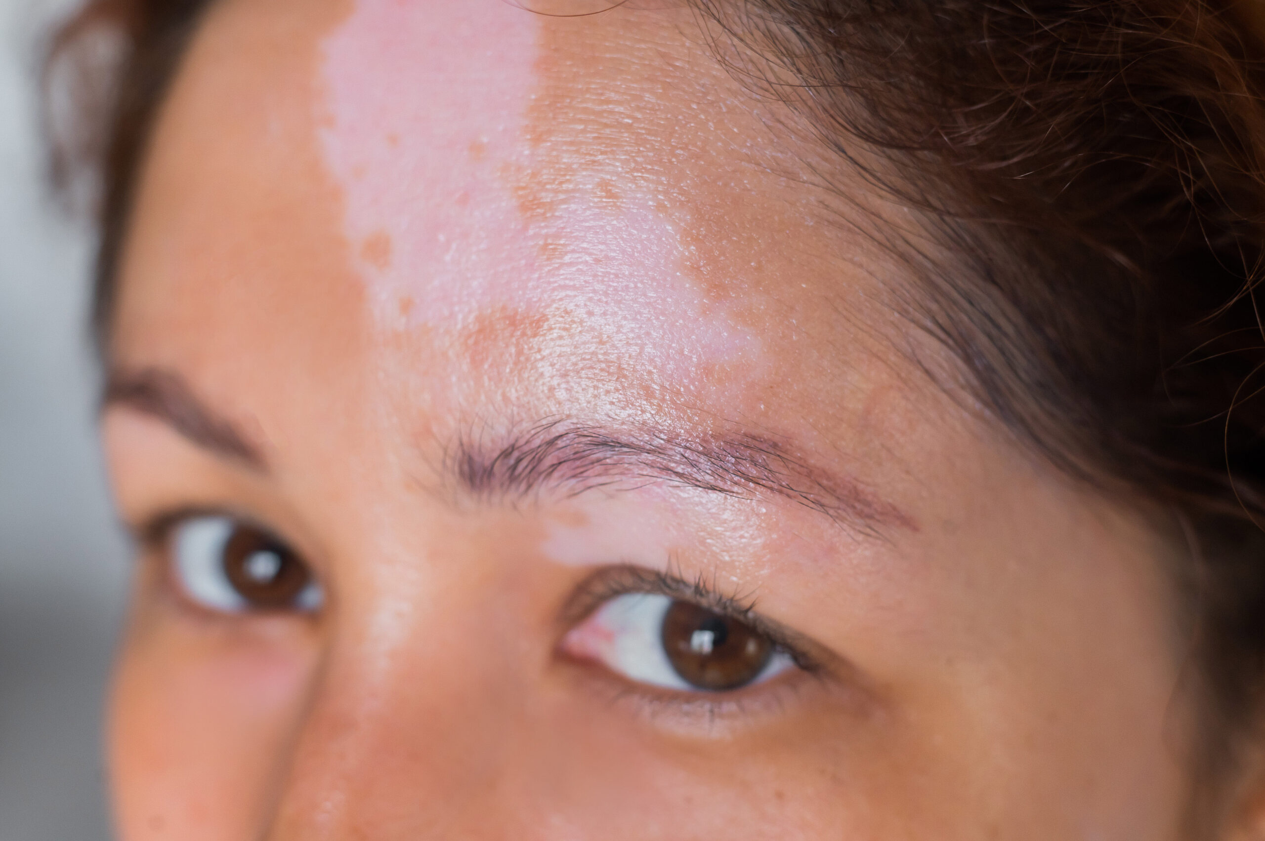 Frau mit Vitiligo im Stirnbereich